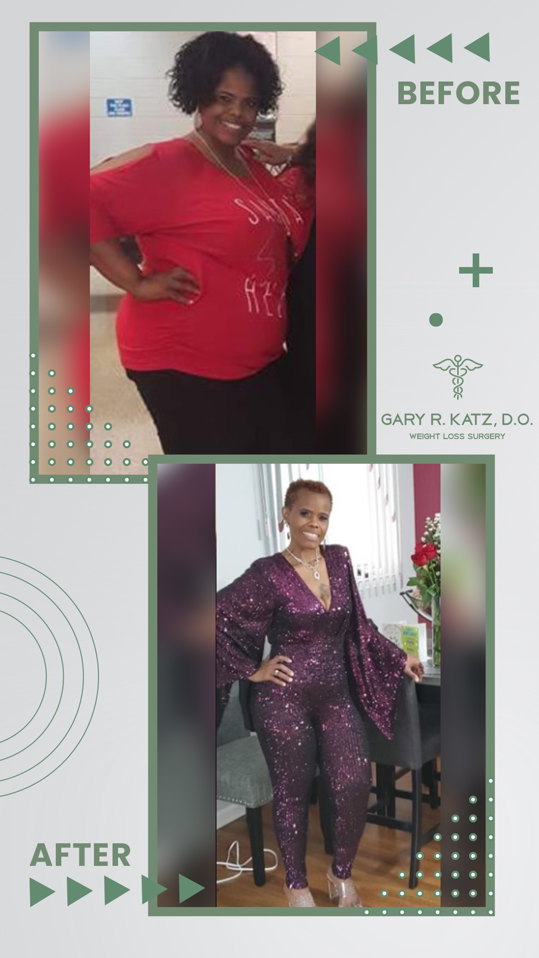 Dr Gary Katz Weight Loss Surgery Before After
