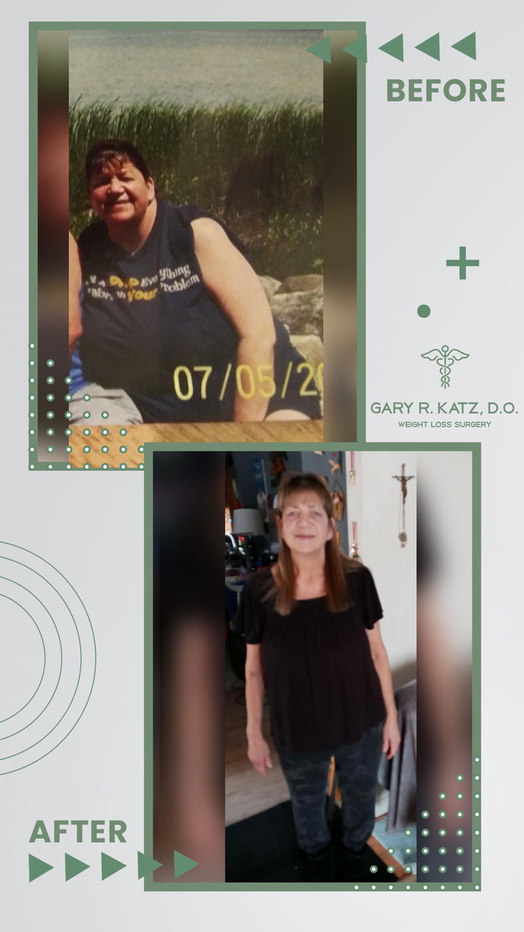 Dr. Gary Katz Weight Loss Surgery Transformation Success Story