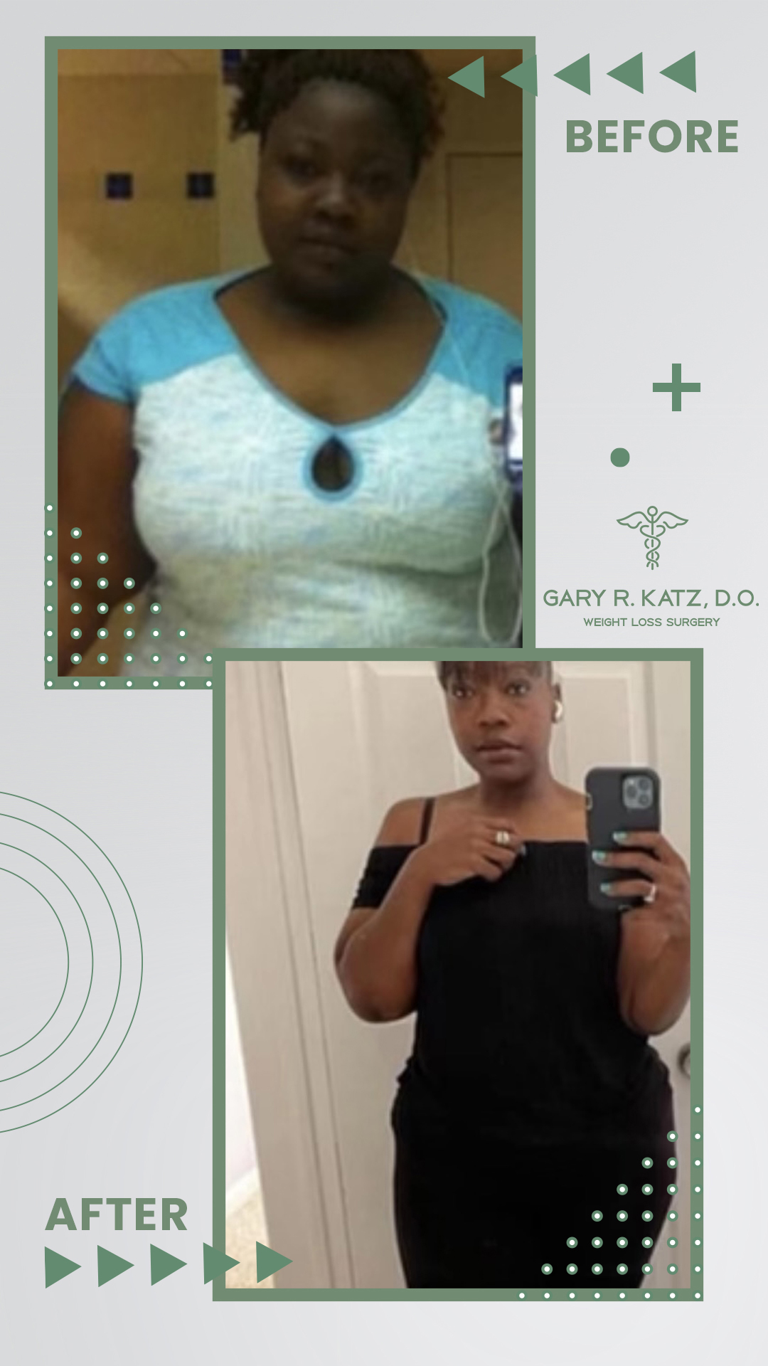 Dr. Gary Katz Weight Loss Surgery Transformation Success Story