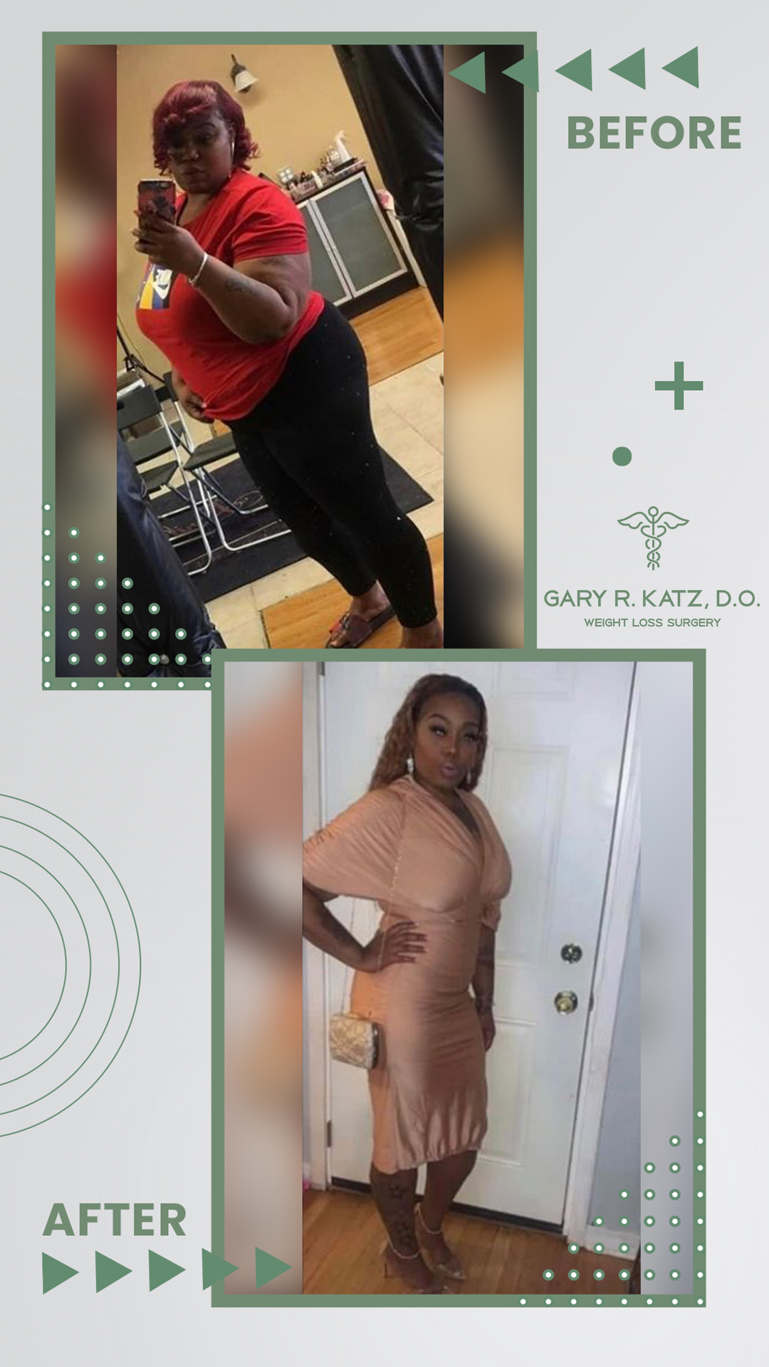 Dr. Gary Katz Weight Loss Surgery Transformation Success Story