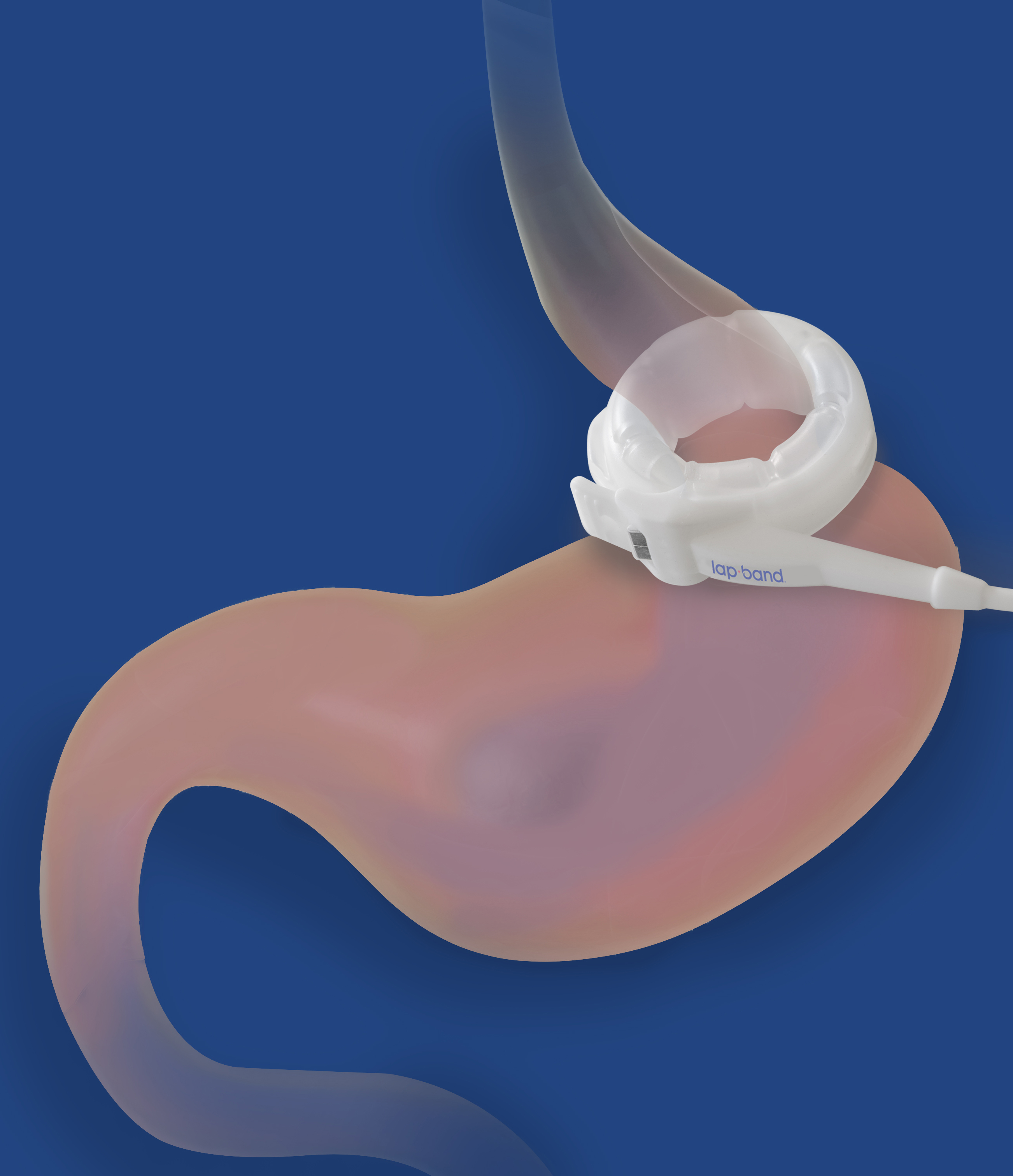 Lap Band 1 Michigan Detroit Weight Loss Surgery